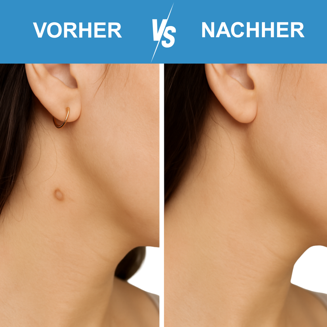 Dermazen™ - Der Stielwarzenentferner