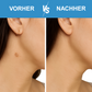 Dermazen™ - Der Stielwarzenentferner